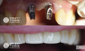 zdjęcia jamy ustnej pacjenta przytobie